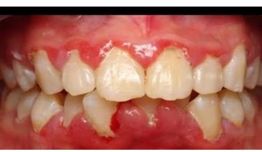 Gum Disease and Periodontal Treatments in Pune - Prasad’s Dental Care