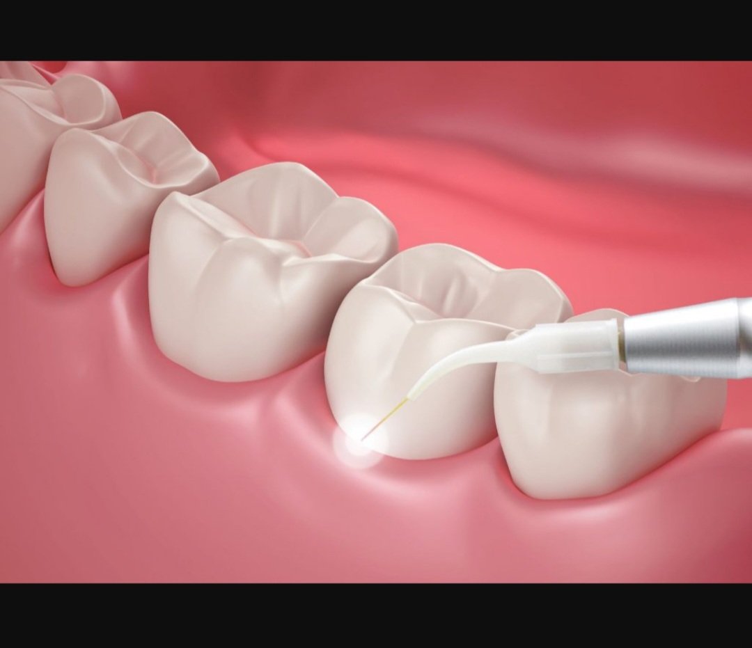 Laser Dentistry Treatment - Prasad’s Dental Care